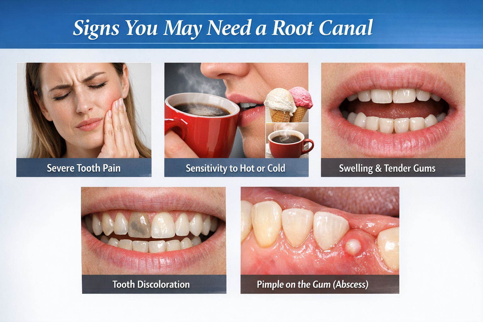 Signs of needing a root canal