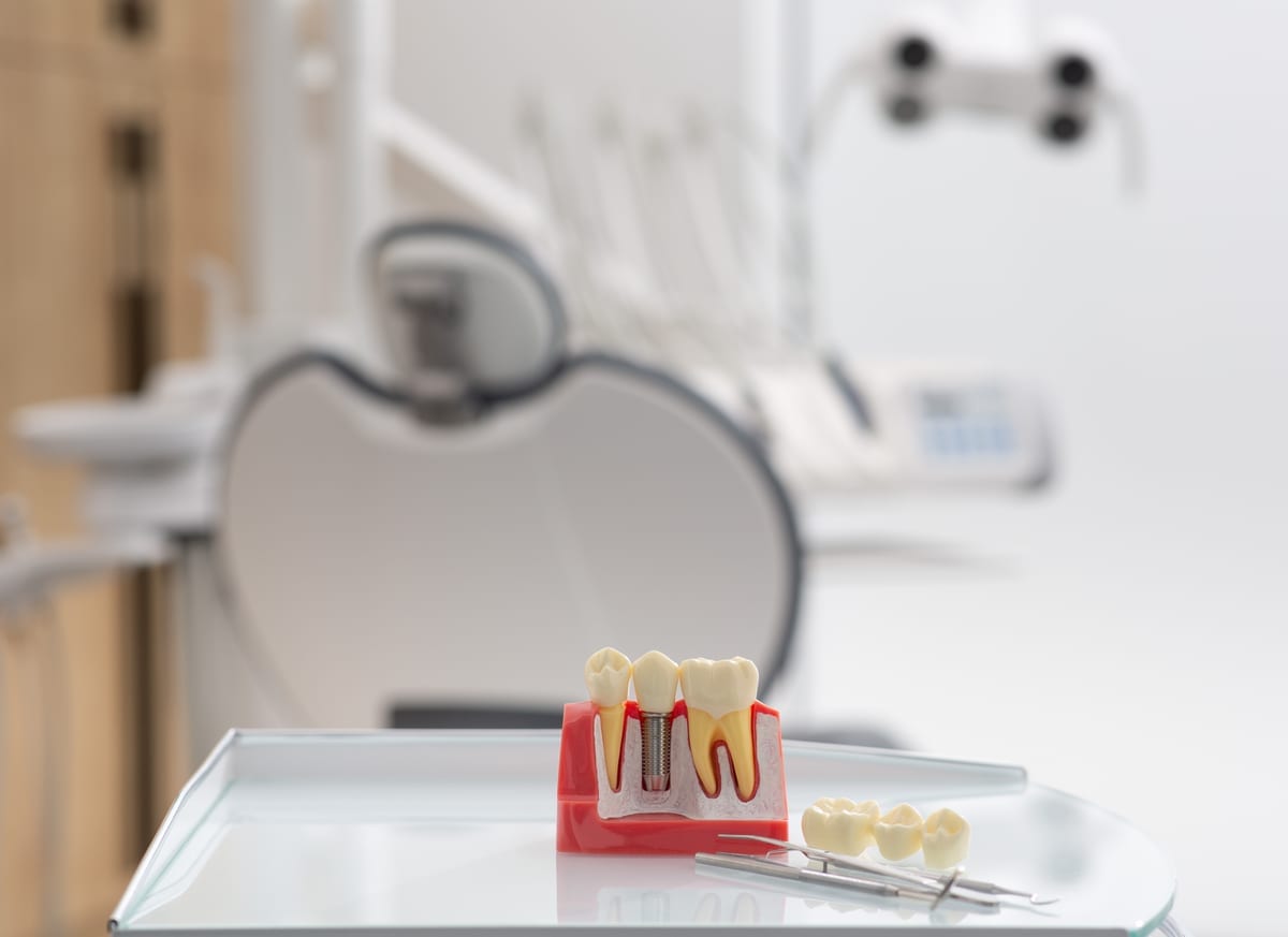 Dental Implants in Fairwood